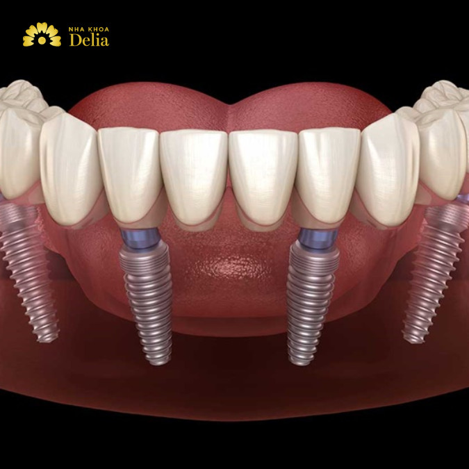 Kỹ thuật trồng răng Implant khi bị mất nhiều răng là một giải pháp phục hồi răng đã mất được ưa chuộng hiện nay