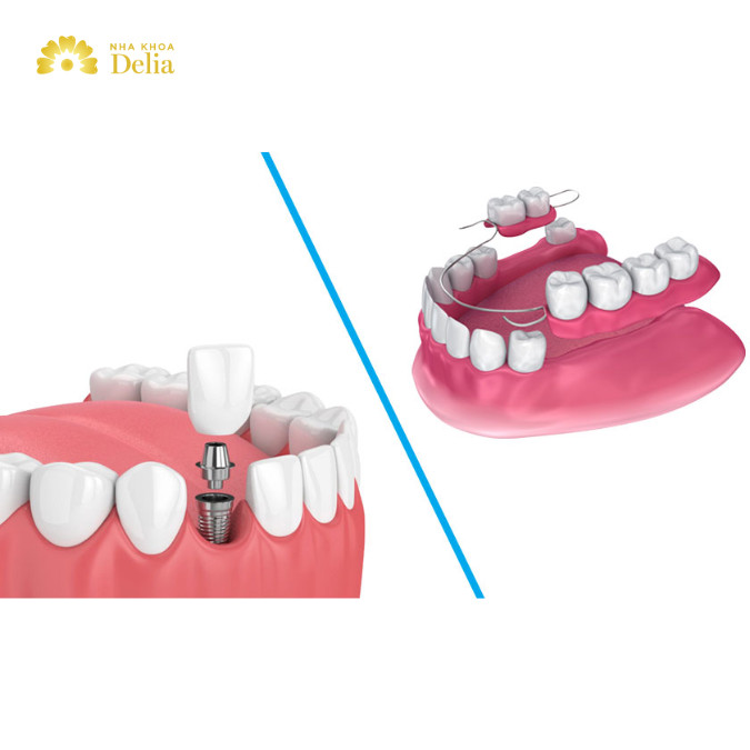 Mất nhiều răng nên trồng răng Implant hay làm hàm giả tháo lắp?