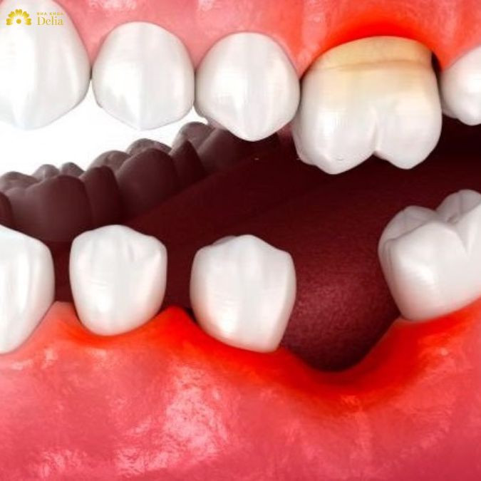 Thực tế, trường hợp này hoàn toàn có thể khắc phục bằng niềng răng