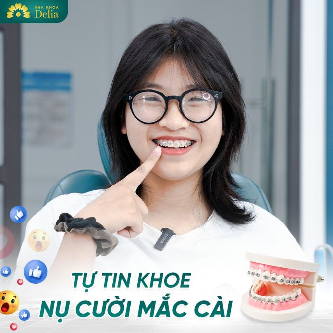 Niềng răng mắc cài