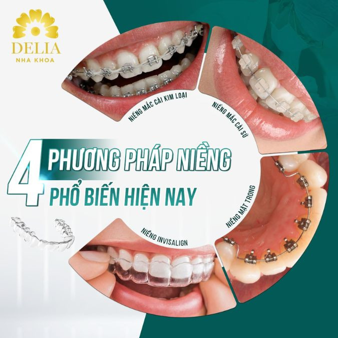 Hiện nay, có hai phương pháp niềng răng chính được sử dụng phổ biến: niềng răng mắc cài và niềng răng không mắc cài