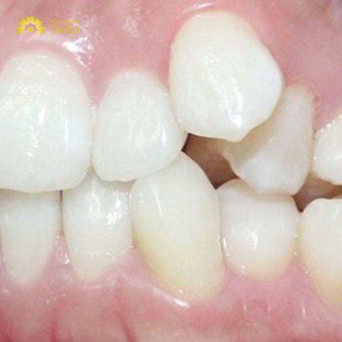 Răng mọc quá chen chúc, nhổ răng có thể là cách duy nhất để tạo đủ không gian cho các răng còn lại