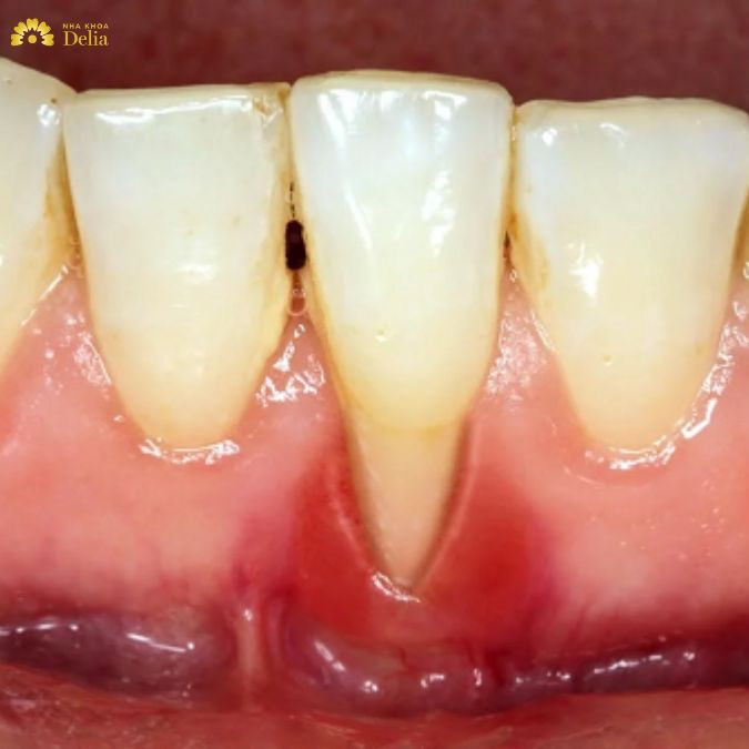 Bệnh nhân mắc bệnh viêm nha chu