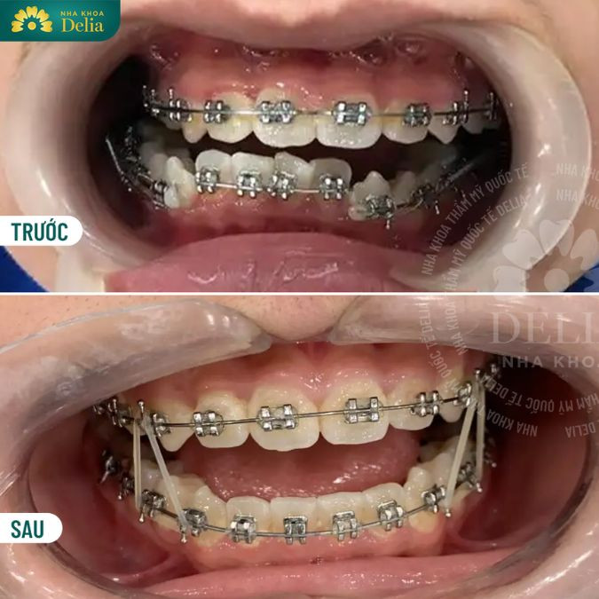 Giai đoạn 2 - Điều chỉnh trục các răng