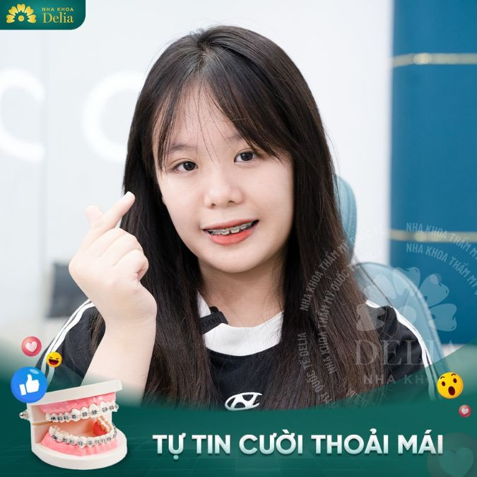 Niềng răng mắc cài kim loại trẻ em