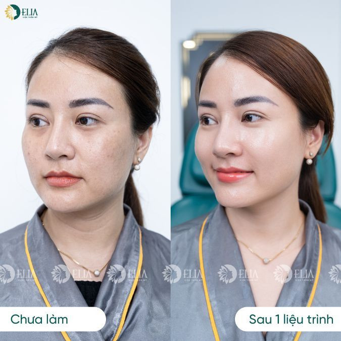 Chăm sóc da mặt tại Elia