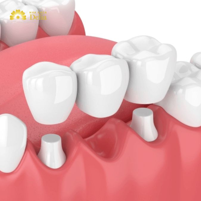 Trồng răng cố định bằng trồng răng Implant hoặc cầu răng sứ