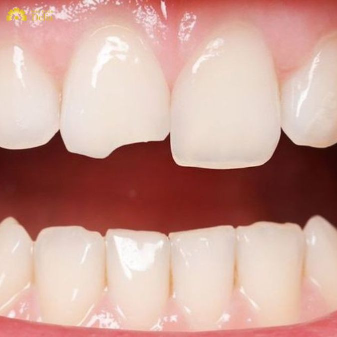 Răng sứ bị mẻ có được bảo hành không?