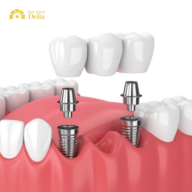 Trồng răng Implant có giá cao hơn rất nhiều so với bắc cầu răng