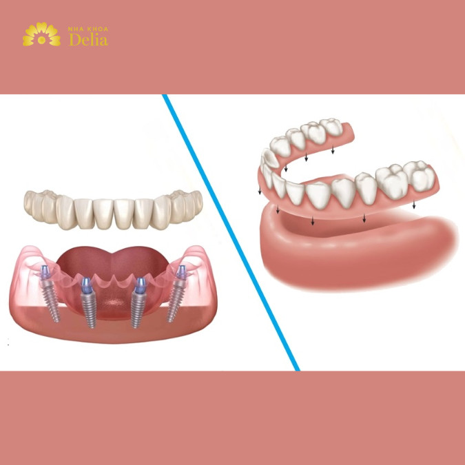 So sánh trồng răng Implant và hàm tháo lắp, phương pháp nào tối ưu hơn?