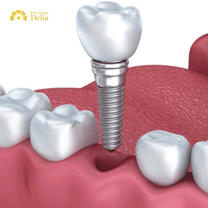Trồng răng Implant là một giải pháp lâu dài, mang lại cảm giác và chức năng gần giống như răng thật