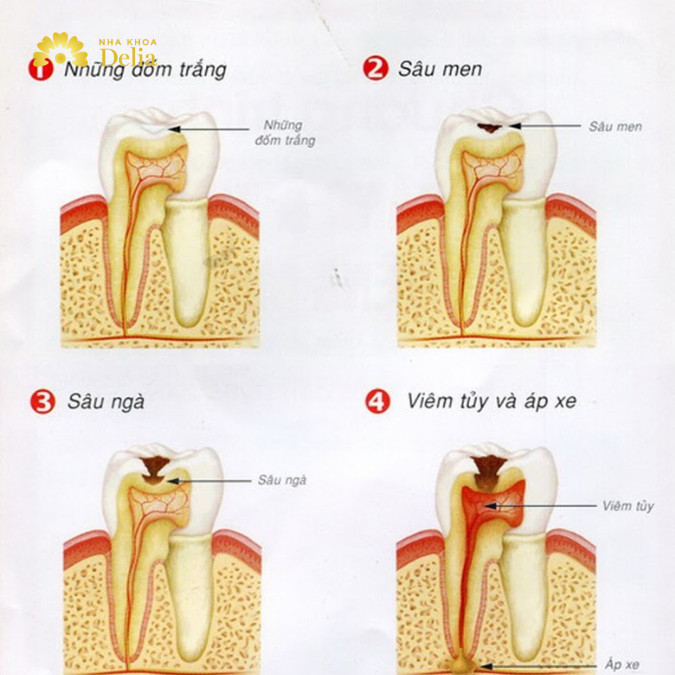 Quá trình vi khuẩn sâu răng phát triển và gây hại cho răng
