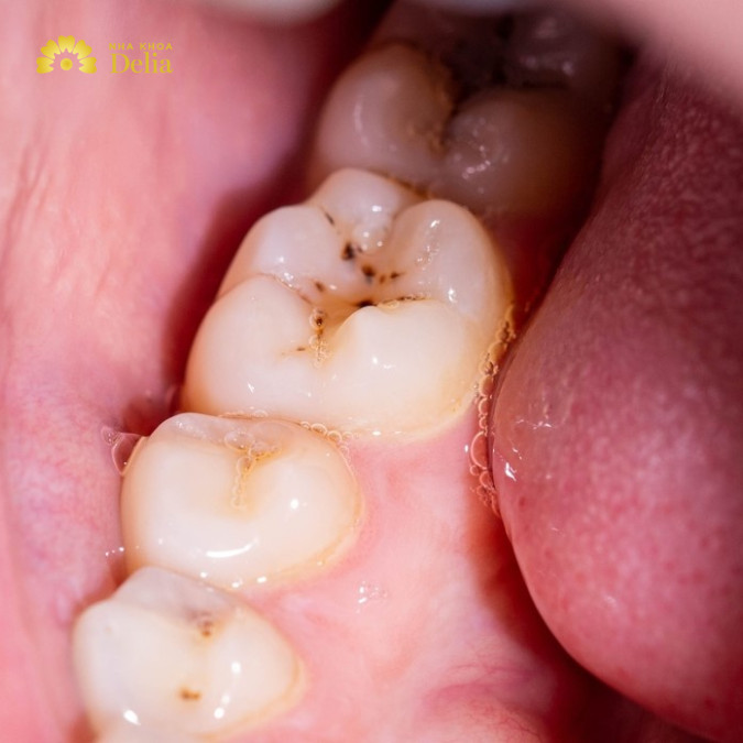 Vi khuẩn gây sâu răng có ảnh hưởng sâu rộng đến sức khỏe răng miệng và có thể dẫn đến nhiều vấn đề nghiêm trọng nếu không được kiểm soát kịp thời.