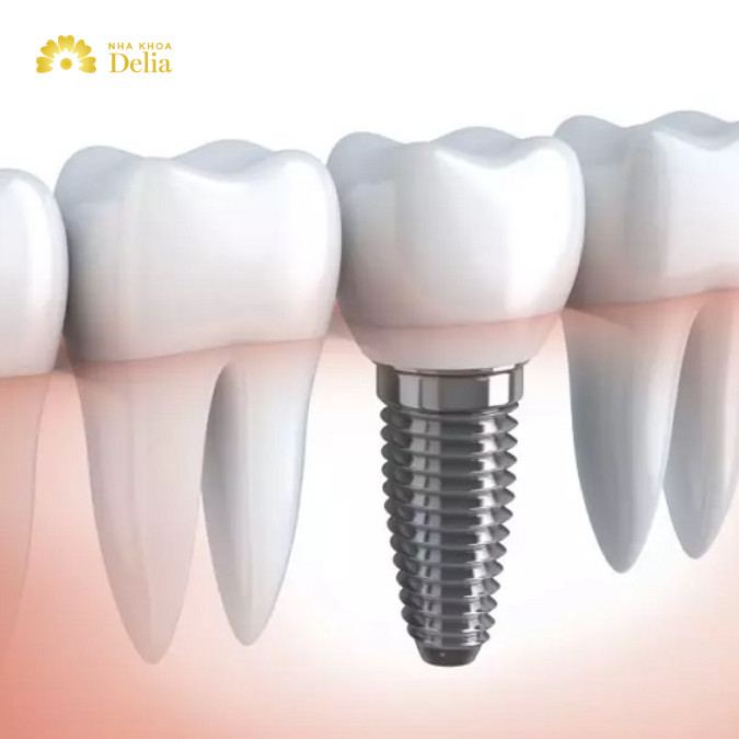 Công nghệ trồng răng Implant đơn lẻ tại Delia
