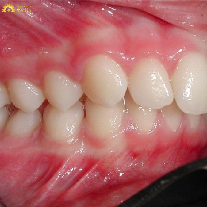 Hô do xương hàm là một tình trạng khá phổ biến
