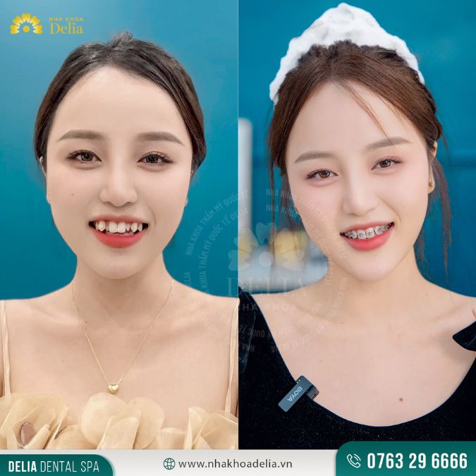 Delia - Địa chỉ cải thiện tình trạng hô nặng hiệu quả
