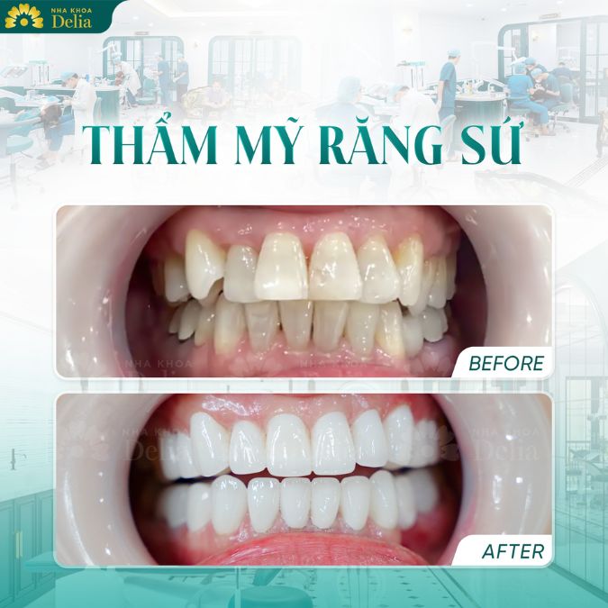 Bọc răng sứ được xem như "phép màu" giúp bạn loại bỏ mọi khuyết điểm của hàm răng