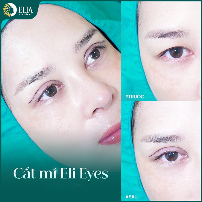 Cắt mí Eli Eyes tạo dáng mắt hạnh nhân
