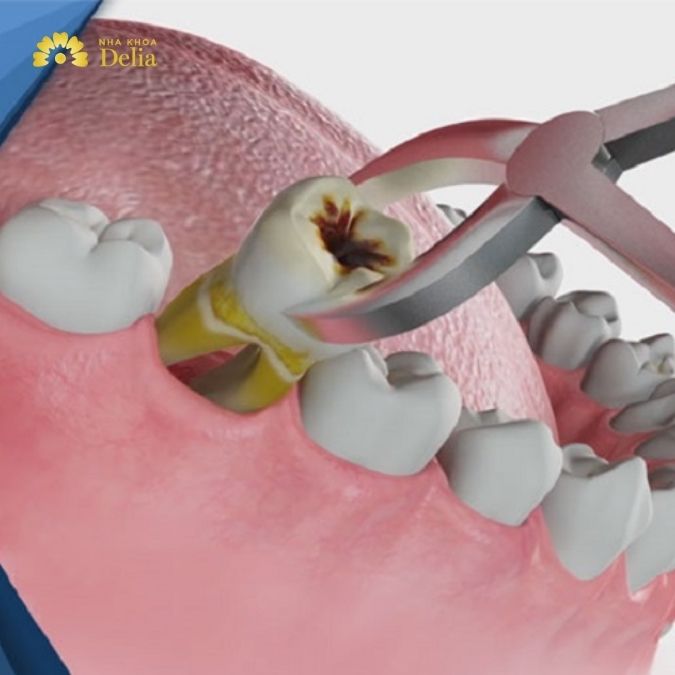 Việc nhổ răng số 6 không nhất thiết dẫn đến tình trạng hóp má