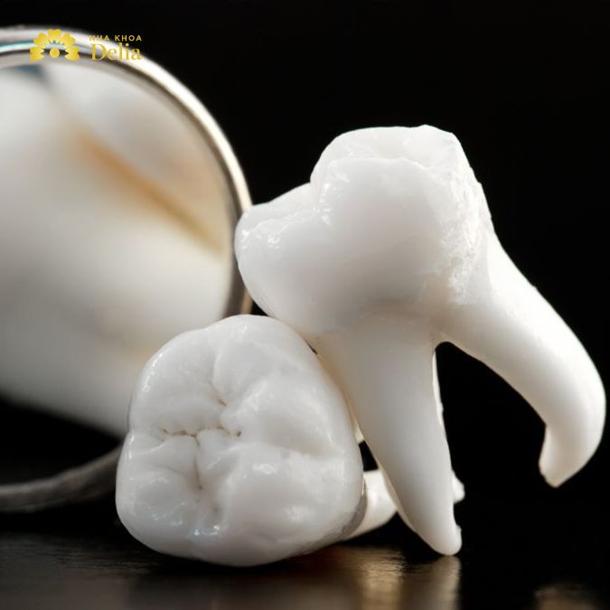 Khi răng số 7 bị sâu nặng, không thể điều trị thì có thể cần nhổ bỏ
