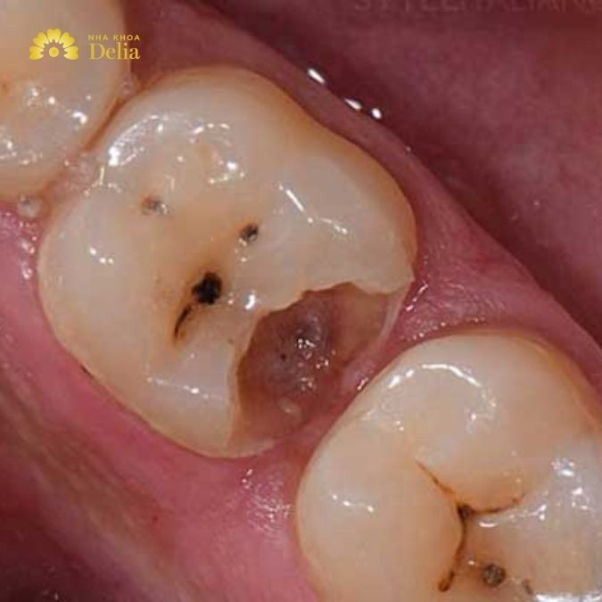 Khi răng số 6 bị sâu vỡ, bạn có một số lựa chọn điều trị để xem xét, tùy thuộc vào mức độ tổn thương của răng