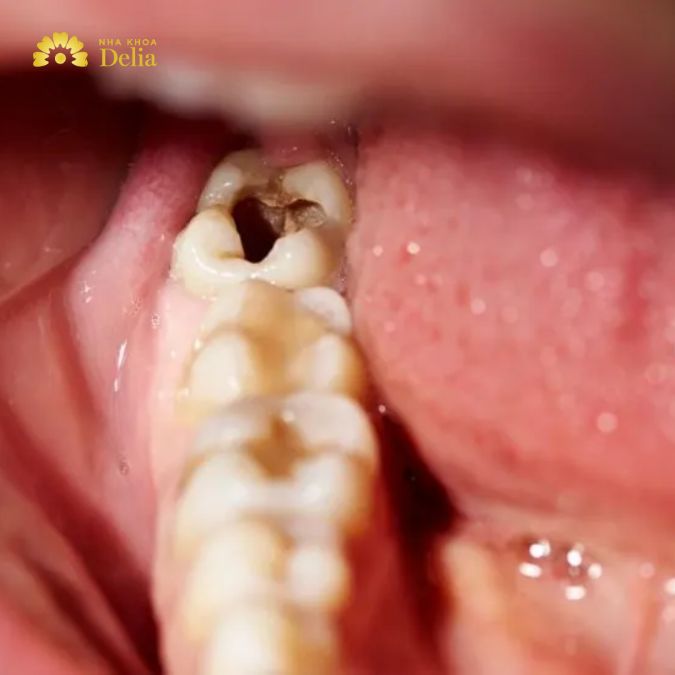 Sâu răng là một trong những vấn đề phổ biến nhất ảnh hưởng đến răng số 7
