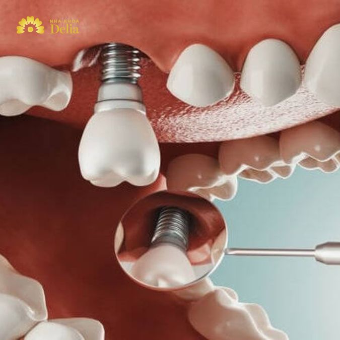 Trong trường hợp răng số 7 bị lung lay quá mức và không thể giữ lại được, trồng răng Implant là phương pháp tốt nhất.