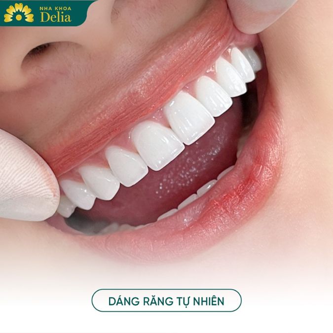 Nếu răng bị vỡ nặng không thể trám đơn giản, bọc răng sứ có thể là lựa chọn tốt.