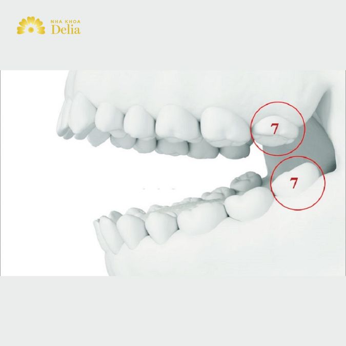Răng số 7 có thay không, có mọc lại không? Bác sĩ giải đáp