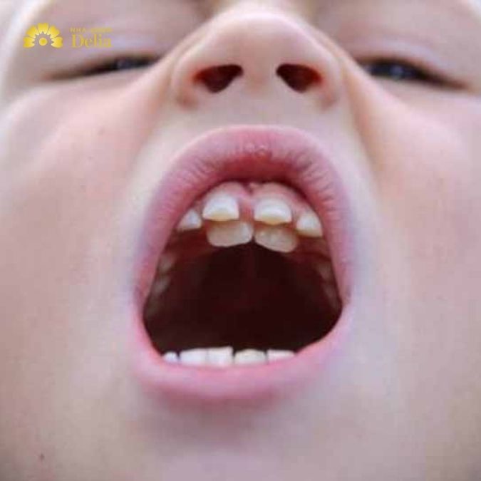 Răng sữa chưa rụng nhưng răng vĩnh viễn đã mọc là một hiện tượng không hiếm gặp trong quá trình thay răng ở trẻ em