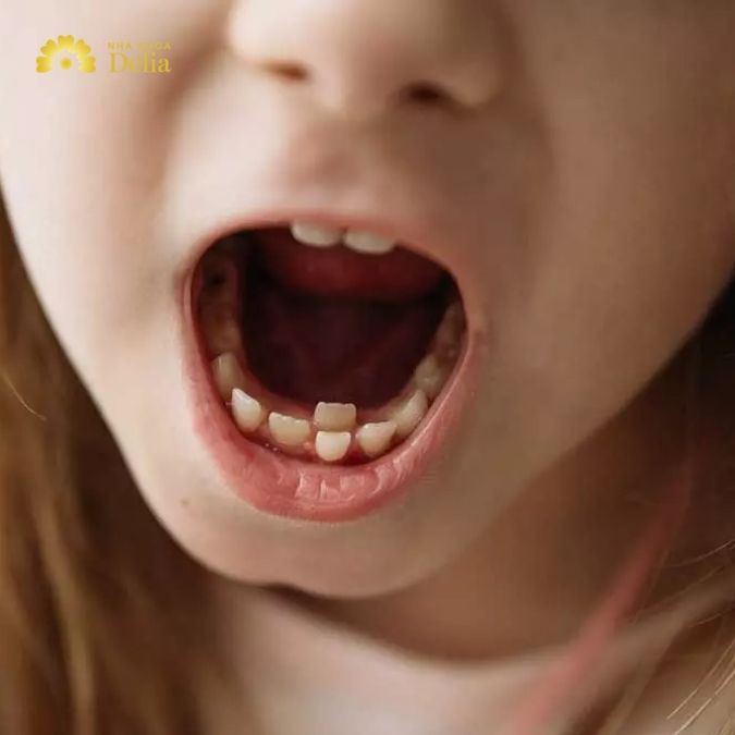 Khi răng sữa chưa rụng mà răng vĩnh viễn đã mọc, điều quan trọng là phải xử lý tình huống này cẩn thận để đảm bảo răng vĩnh viễn có thể mọc đúng vị trí và khỏe mạnh