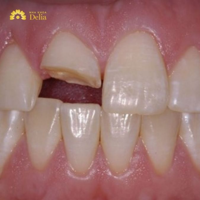 Răng vĩnh viễn không mọc lại sau khi rụng hoặc bị nhổ