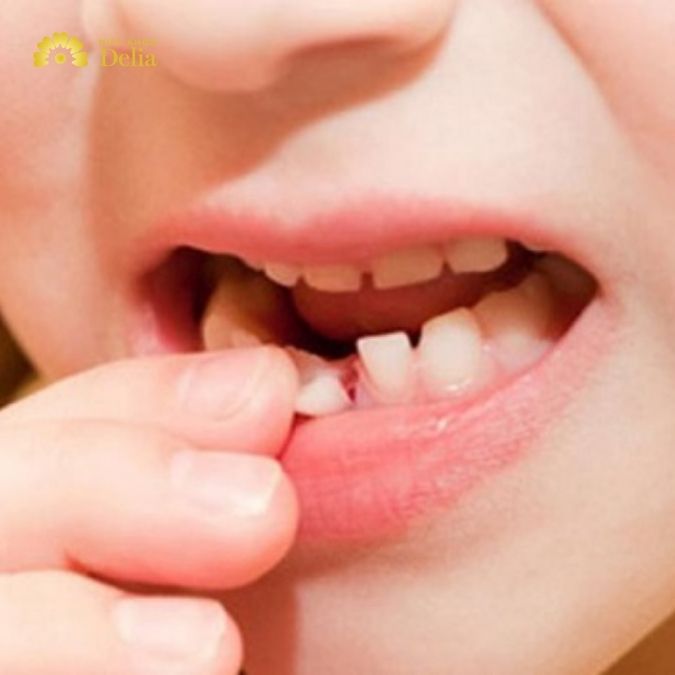 Răng vĩnh viễn bị lung lay thì phải làm sao? Hỏi đáp nhanh với bác sĩ