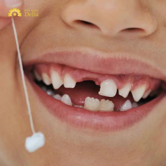 Trẻ thường bắt đầu thay răng sữa vào độ tuổi từ 6 đến 12 tuổi.