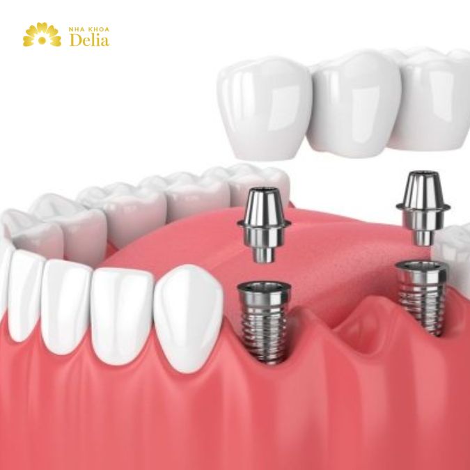 Trồng răng Implant là một phương pháp phục hồi răng đã mất hiện đại nhất hiện nay
