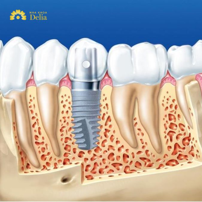 Khi nhắc đến trồng răng Implant, nhiều người thường e ngại về chi phí và cho rằng đây là một phương pháp đắt đỏ.