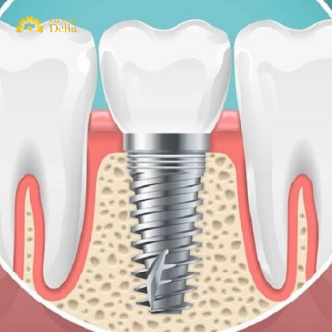 Nha khoa Delia tự hào là một trong những địa chỉ hàng đầu trong lĩnh vực trồng răng Implant chất lượng cao
