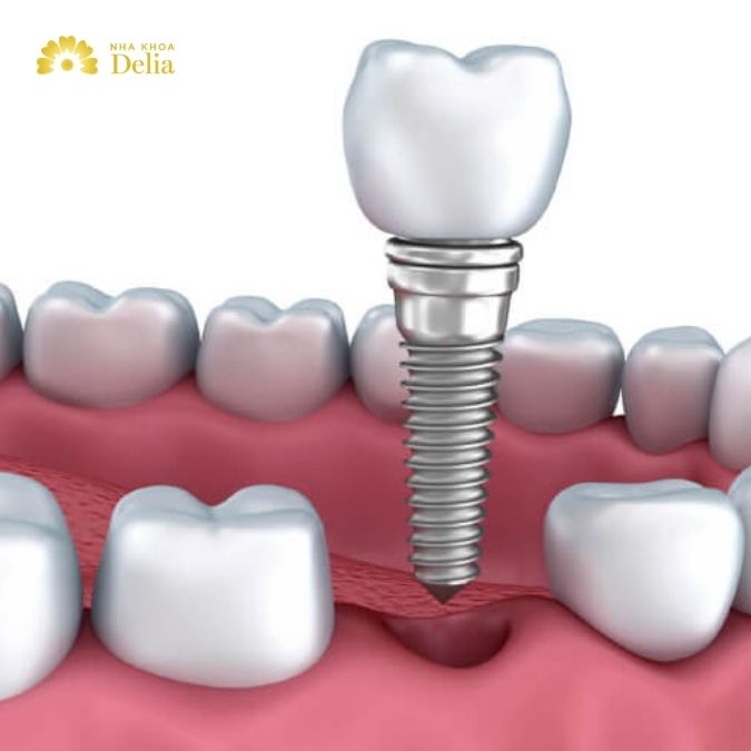 Mật độ và lượng xương hàm đủ để hỗ trợ trụ Implant là yếu tố quan trọng nhất đẻ trồng răng Implant tức thì