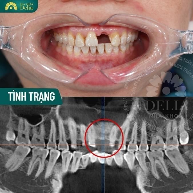 Quy trình thực hiện trồng răng Implant tức thì với răng đơn lẻ