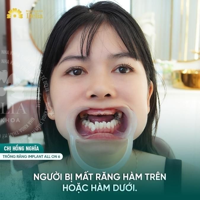 Quy trình thực hiện trồng răng Implant tức thì với răng Implant toàn hàm