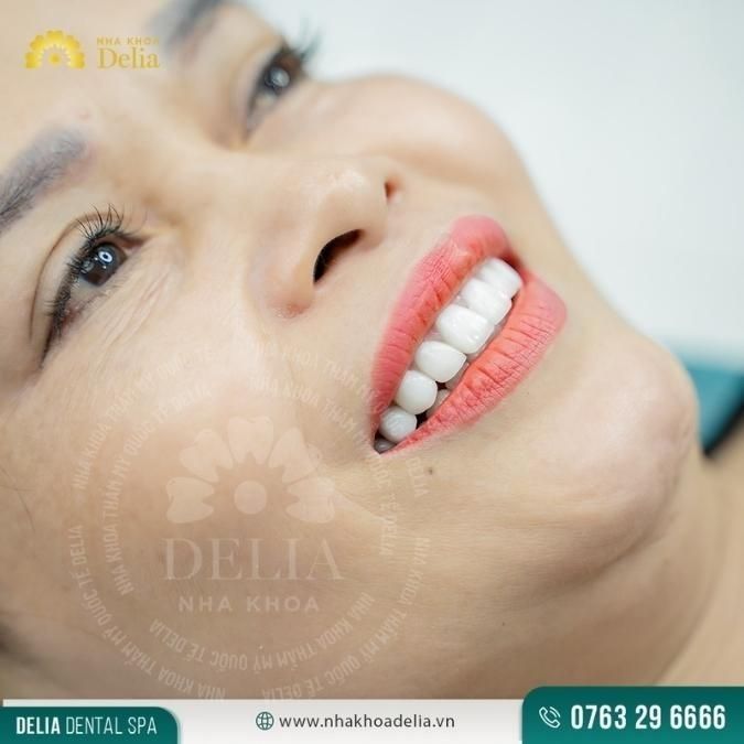 Tôi rất ấn tượng với dịch vụ trồng răng Implant tức thì tại Delia