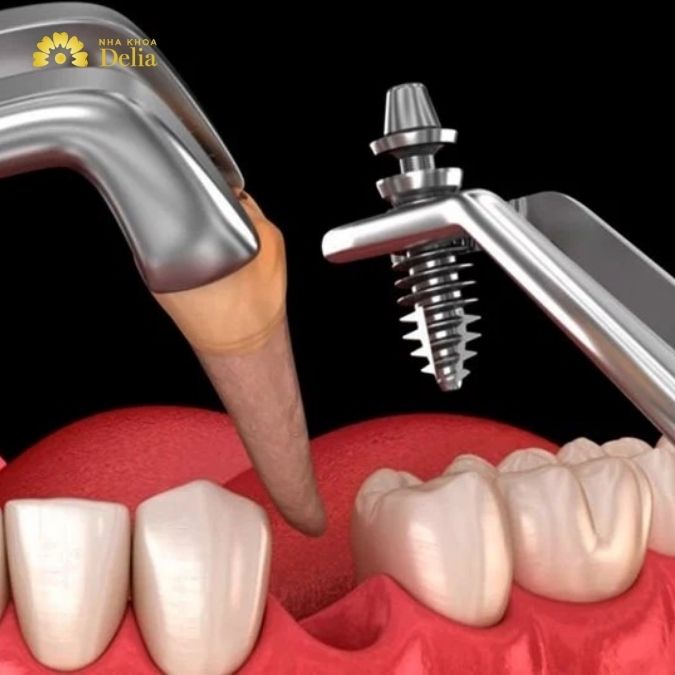 Trồng răng Implant tức thì nhanh nhất ở đâu đảm bảo chất lượng?