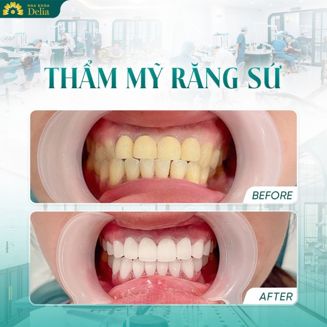 Sau khi răng sứ được chế tác xong, bác sĩ sẽ tiến hành gắn răng sứ lên răng thật