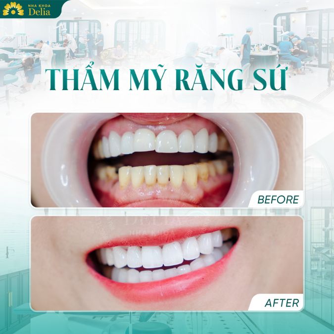 Răng sứ HT Smile là sản phẩm của hãng H.C. Starck (Đức), nổi tiếng với chất lượng cao và độ thẩm mỹ vượt trội