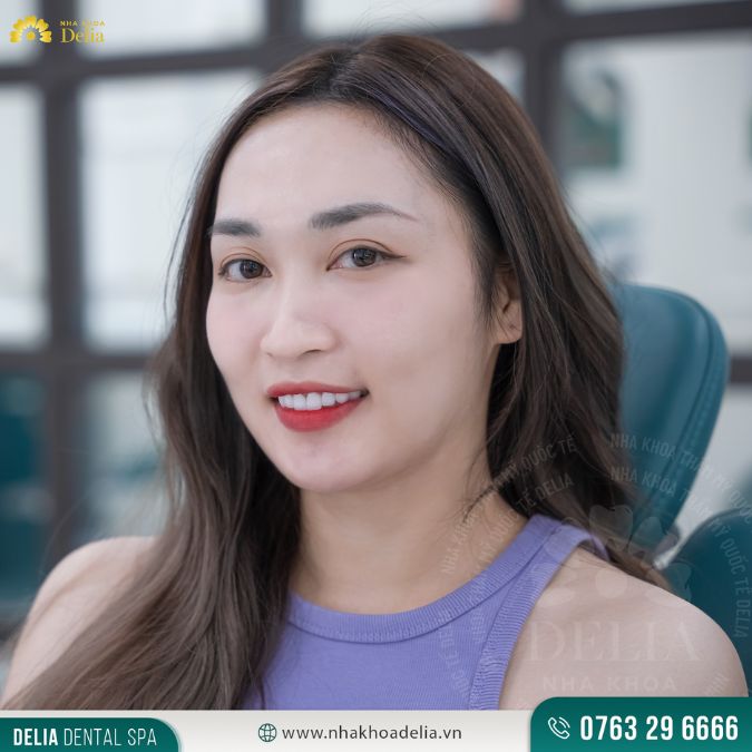 Chị Thúy Kiều - Thẩm mỹ răng sứ Emax: "Tôi ấn tượng với sự tận tâm và chu đáo của bác sĩ Thái Hà. Bác sĩ luôn lắng nghe và giải đáp mọi thắc mắc của tôi. Bác sĩ không chỉ là một người bác sĩ mà còn là một người bạn, luôn đồng hành cùng tôi trong suốt quá trình điều trị."