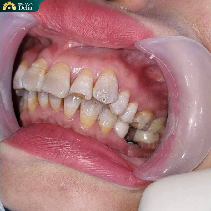 Nếu không được làm sạch, cao răng sẽ tạo môi trường thuận lợi cho vi khuẩn phát triển