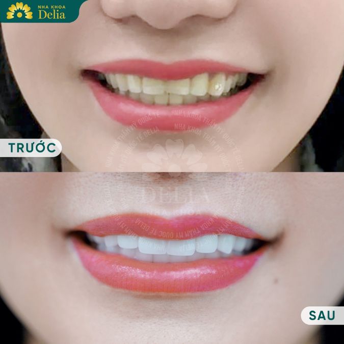 Khi răng sứ đã hoàn thiện, bác sĩ sẽ tiến hành gắn răng sứ vào vị trí đã chuẩn bị