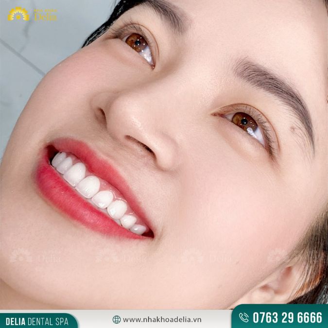 Chương trình khuyến mãi bọc răng sứ 