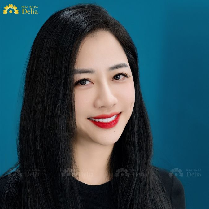 Răng sứ kim loại là một trong những loại răng sứ ra đời sớm nhất, được nhiều người biết đến nhờ độ bền cao