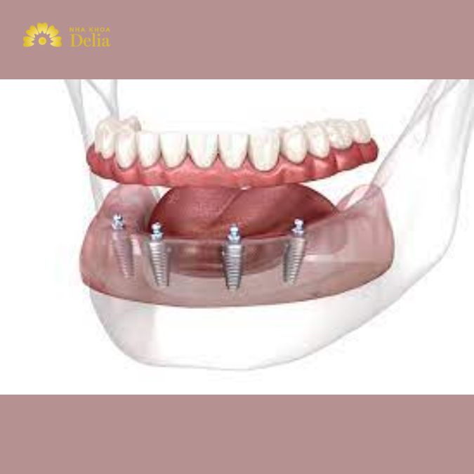 Benefits of All in one Implants